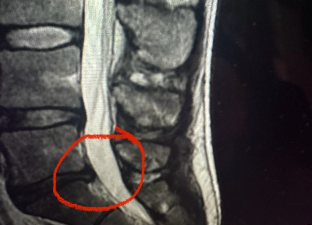My Top 4 Hunting Injuries & How I Dealt With Them