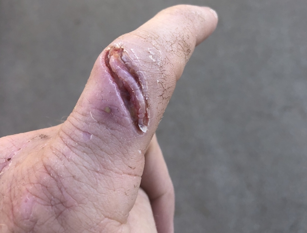 My Top 4 Hunting Injuries & How I Dealt With Them